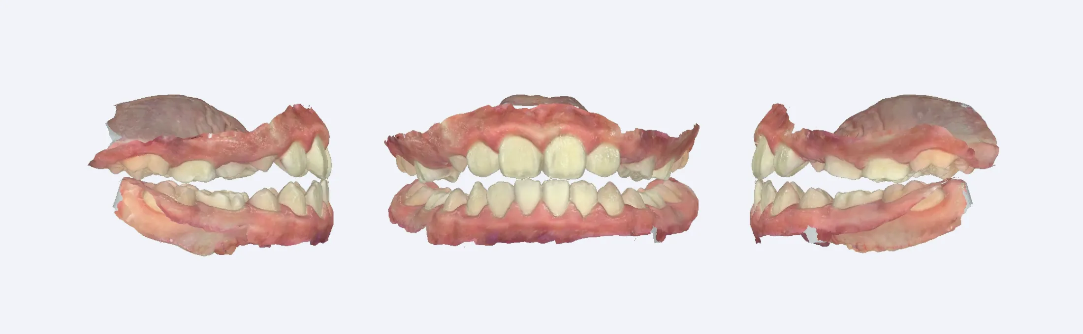 functional appliance and splint