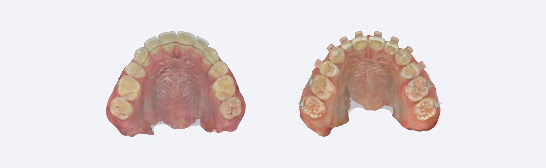 removable-retainer